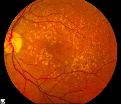 Understanding Macular Degeneration