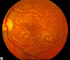Understanding Macular Degeneration